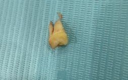 孕妇梦到牙齿脱落