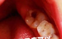 女人梦见牙齿坏了掉了有什么寓意 女人梦见拔掉蛀牙却不疼代表什么