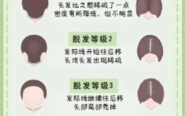 男性脱发原因解析 男性脱发应对方法