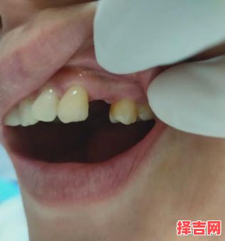 女人梦中下牙脱落新生与补牙失落-第1张图片